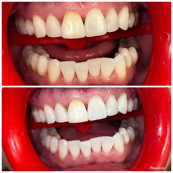 Teeth Whitening Before and After