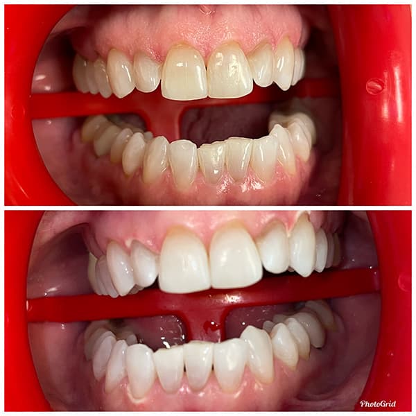 Teeth Whitening Before and After