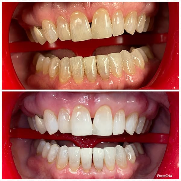 Teeth Whitening Before and After