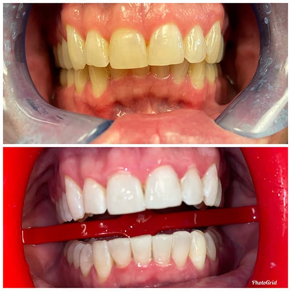 Teeth Whitening Before and After