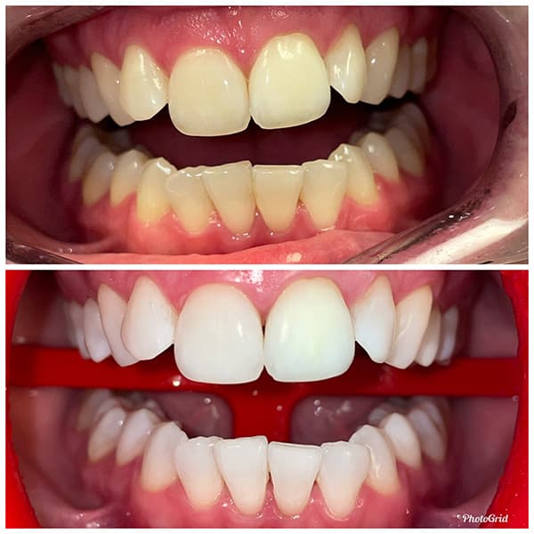 Teeth Whitening Before and After