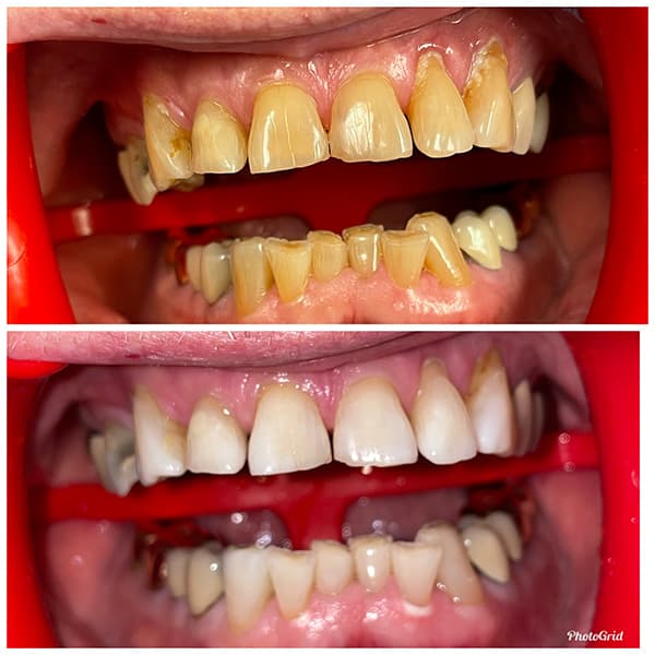 Teeth Whitening Before and After