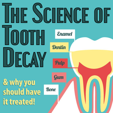 Highlands Ranch dentists, Dr. Twiss of Twiss Dental, discuss the science of tooth decay: what it is and what you can do to prevent it.